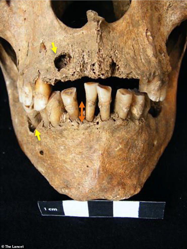 考古学者は遺体が病気だらけであることを知りませんでしたが、頭蓋骨には、平均よりも大きな歯や、死ぬ前に口の軟部組織を損傷した深刻な歯肉感染症などの痕跡が特徴です。